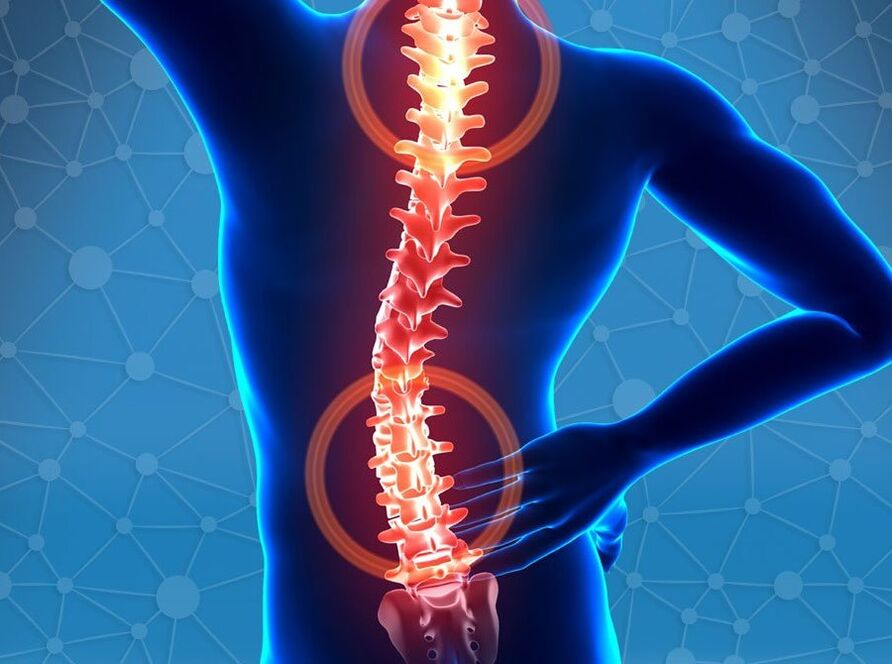 Osteocondrosi della colonna vertebrale