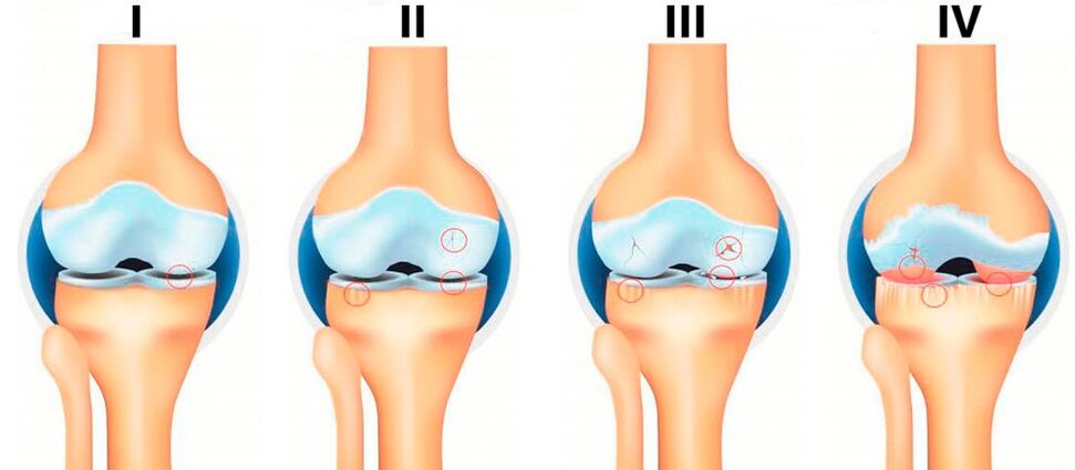 Fasi dell'osteoartrosi