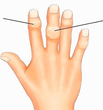 Nodi di Heberden e Bouchard alle articolazioni interfalangee con osteoartrosi