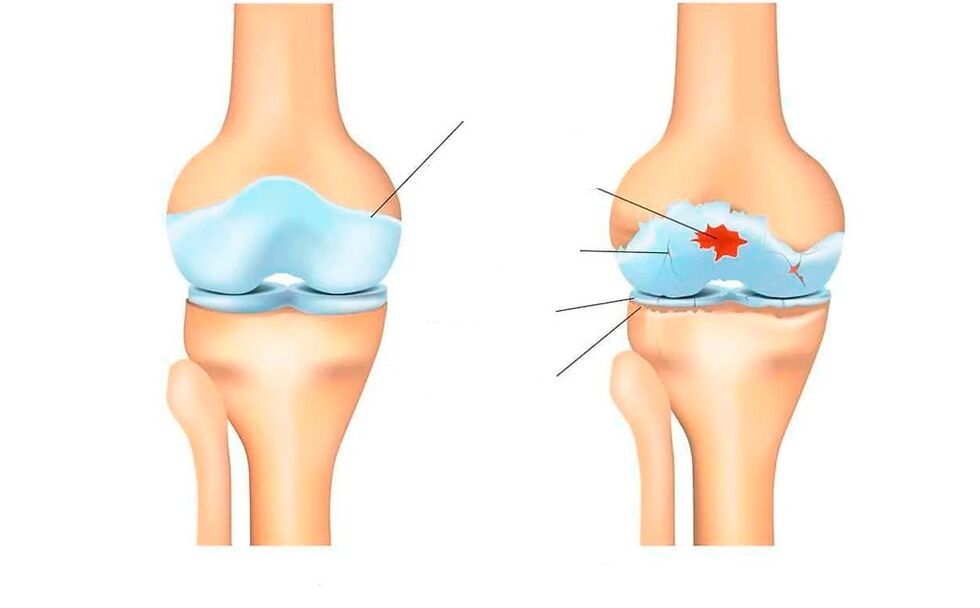 articolazione sana e per l'artrosi