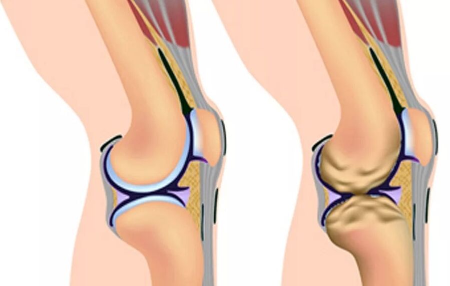 Il primo grado di osteoartrosi del ginocchio