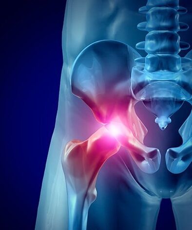 Dolore all'anca, foto 1