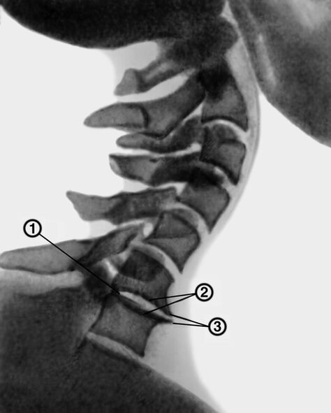 Radiografia del rachide cervicale con osteocondrosi