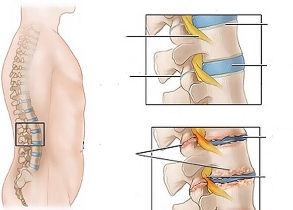 Cambiamenti nei dischi intervertebrali dovuti all'osteocondrosi