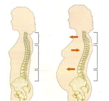 Osteocondrosi in gravidanza